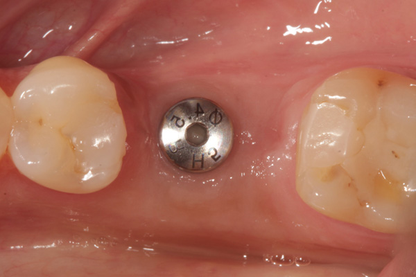 implant case before 3