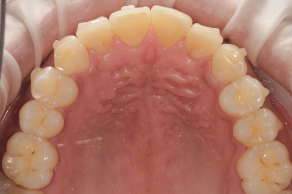 invisalign case after 2