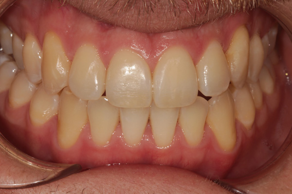 invisalign case after 4