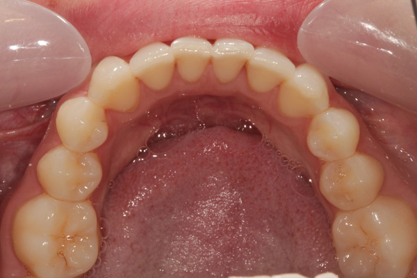 invisalign case after 5