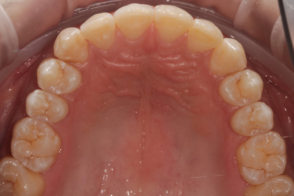 invisalign case after 6