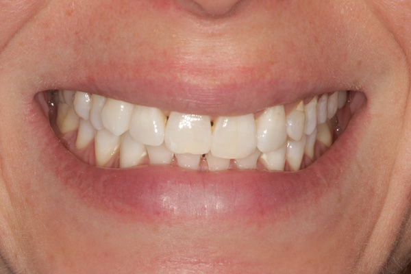 whitening case after 1