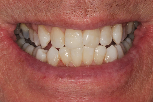whitening case after 3