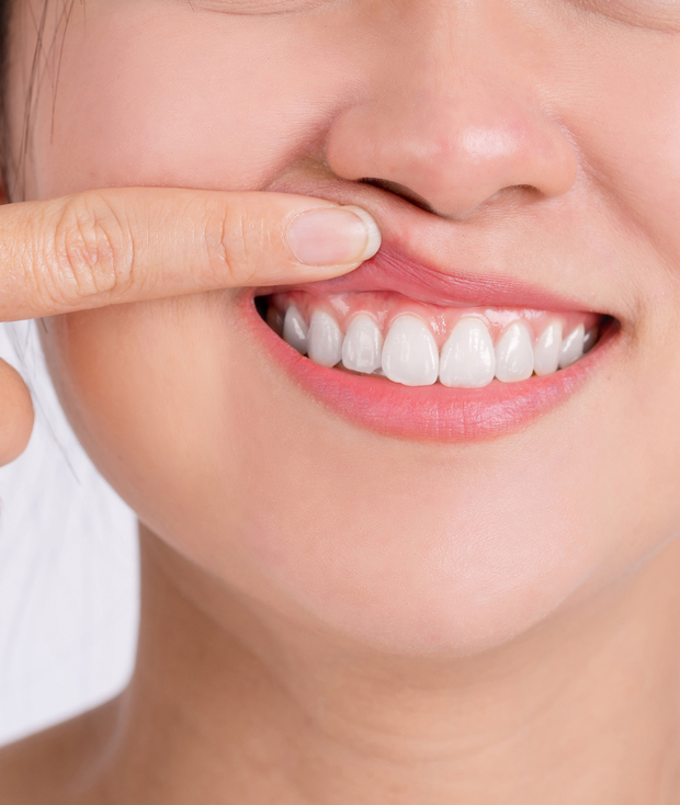 What causes Gum Disease?