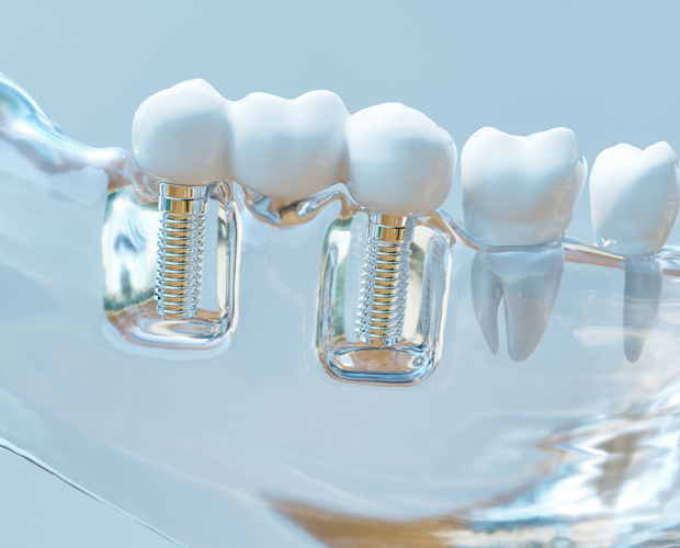 When is a sinus lift required for dental implants?